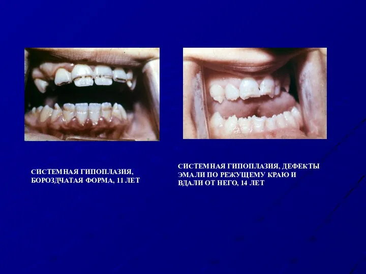 СИСТЕМНАЯ ГИПОПЛАЗИЯ, БОРОЗДЧАТАЯ ФОРМА, 11 ЛЕТ СИСТЕМНАЯ ГИПОПЛАЗИЯ, ДЕФЕКТЫ ЭМАЛИ ПО