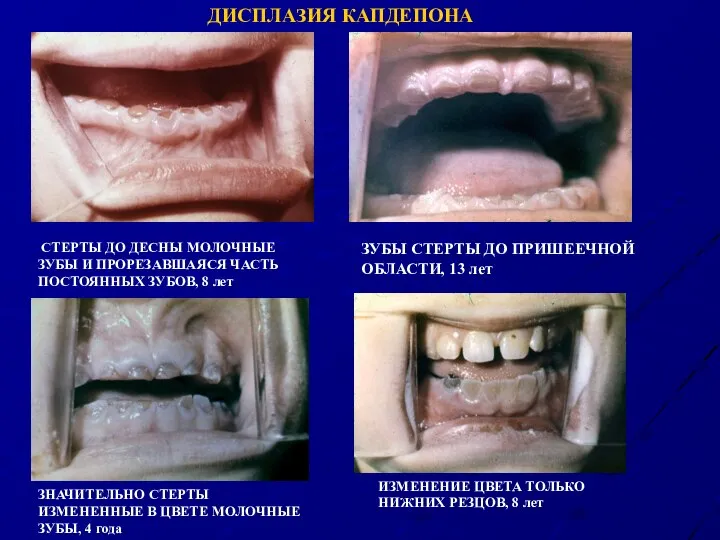 ЗУБЫ СТЕРТЫ ДО ПРИШЕЕЧНОЙ ОБЛАСТИ, 13 лет СТЕРТЫ ДО ДЕСНЫ МОЛОЧНЫЕ