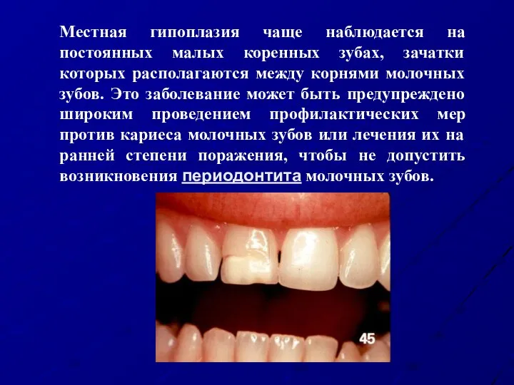 Местная гипоплазия чаще наблюдается на постоянных малых коренных зубах, зачатки которых