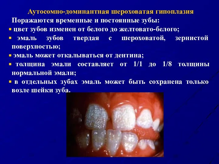 Аутосомно-доминантная шероховатая гипоплазия Поражаются временные и постоянные зубы: цвет зубов изменен