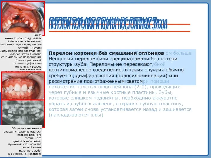 ТРАВМА ЗУБА ПЕРЕЛОМ МОЛОЧНЫХ РЕЗЦОВ Денто-альвеолярный перелом. Такой перелом больше распространен