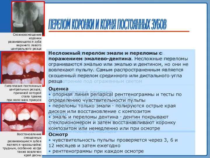 ТРАВМА ЗУБА ПЕРЕЛОМ КОРОНКИ И КОРНЯ ПОСТОЯННЫХ ЗУБОВ Гипоплазия постоянных центральных