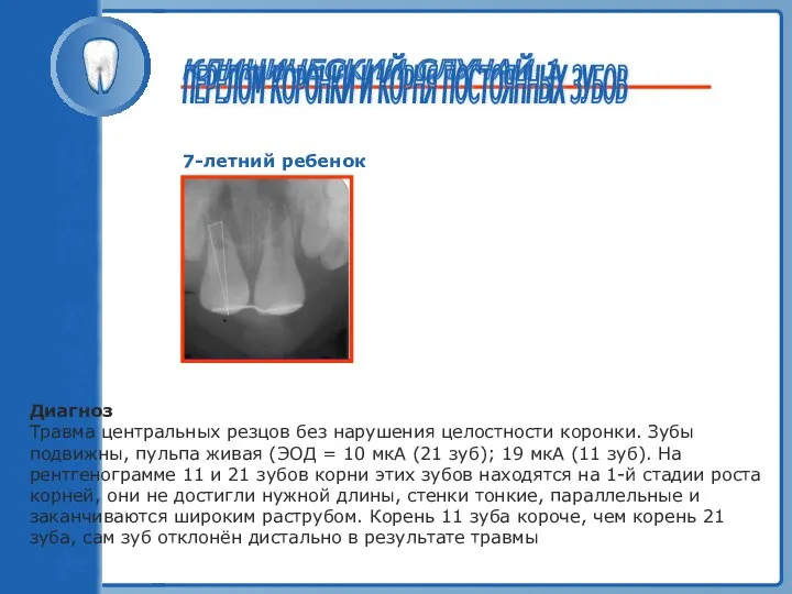 ТРАВМА ЗУБА КЛИНИЧЕСКИЙ СЛУЧАЙ 1 ПЕРЕЛОМ КОРОНКИ И КОРНЯ ПОСТОЯННЫХ ЗУБОВ