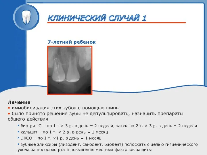 ТРАВМА ЗУБА 7-летний ребенок Лечение • иммобилизация этих зубов с помощью