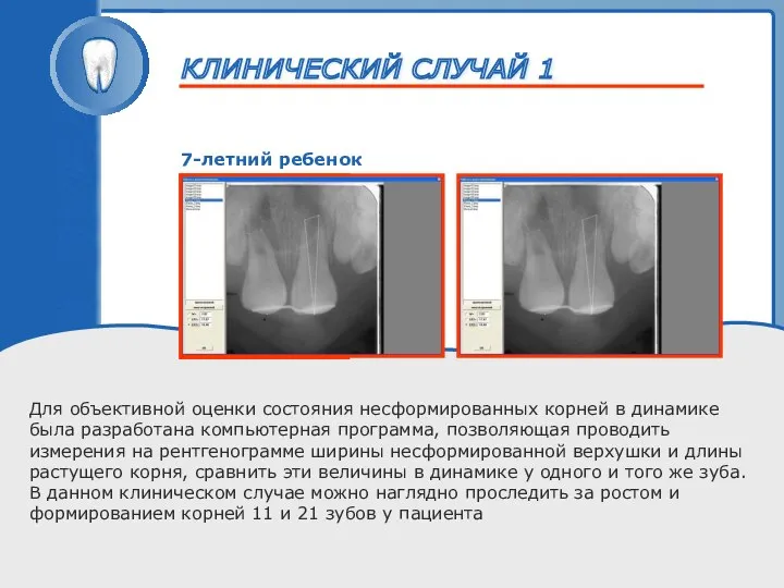 ТРАВМА ЗУБА 7-летний ребенок Для объективной оценки состояния несформированных корней в