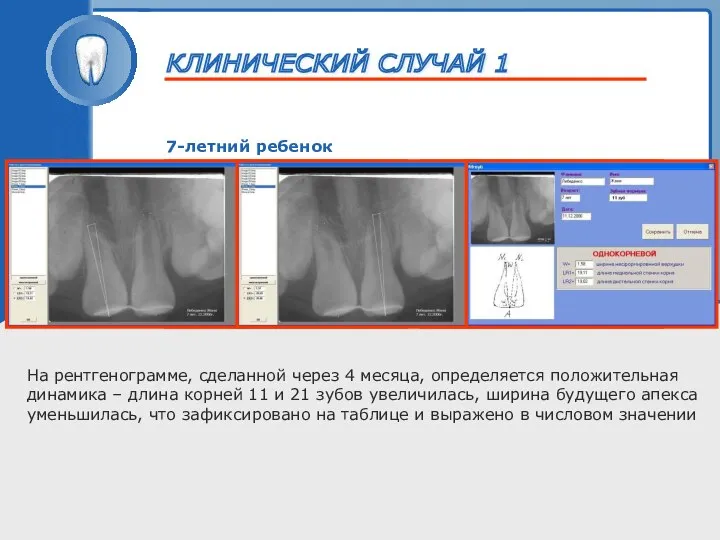 ТРАВМА ЗУБА 7-летний ребенок На рентгенограмме, сделанной через 4 месяца, определяется