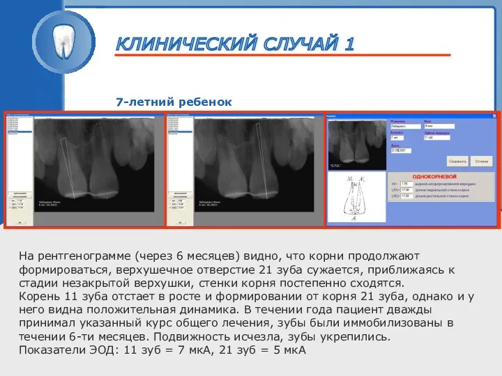 ТРАВМА ЗУБА 7-летний ребенок На рентгенограмме (через 6 месяцев) видно, что