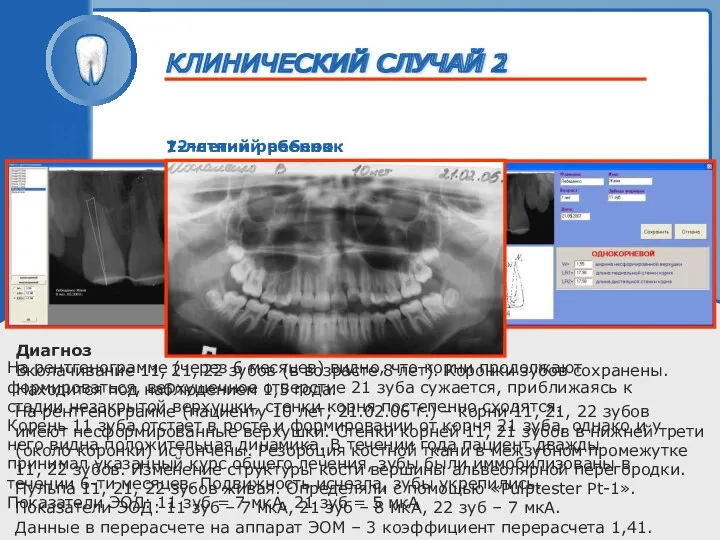 ТРАВМА ЗУБА 7-летний ребенок На рентгенограмме (через 6 месяцев) видно, что