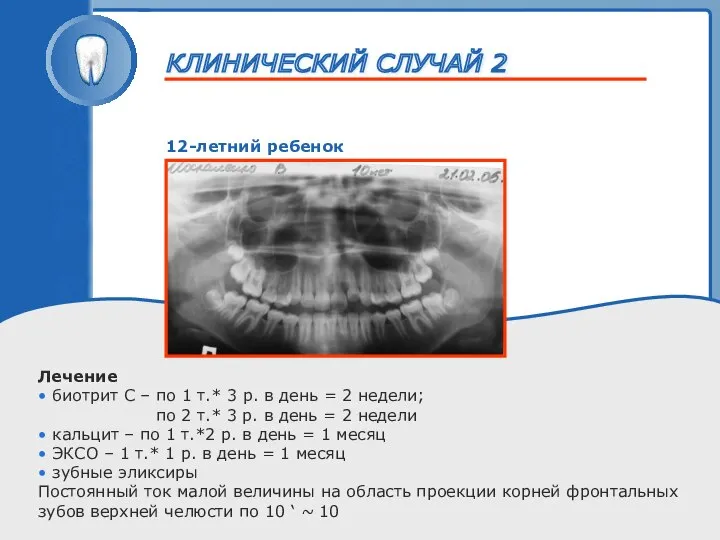 ТРАВМА ЗУБА 12-летний ребенок Лечение • биотрит С – по 1
