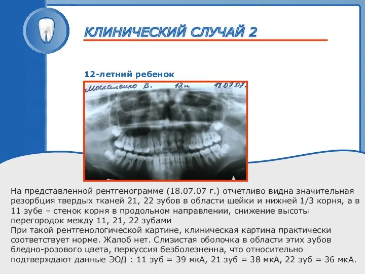 ТРАВМА ЗУБА 12-летний ребенок На представленной рентгенограмме (18.07.07 г.) отчетливо видна