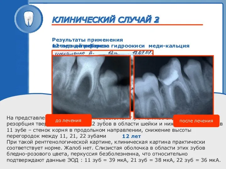 ТРАВМА ЗУБА 12-летний ребенок На представленной рентгенограмме (18.07.07 г.) отчетливо видна