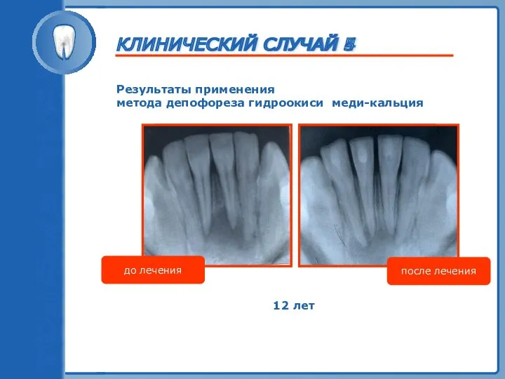 ТРАВМА ЗУБА Результаты применения метода депофореза гидроокиси меди-кальция до лечения после