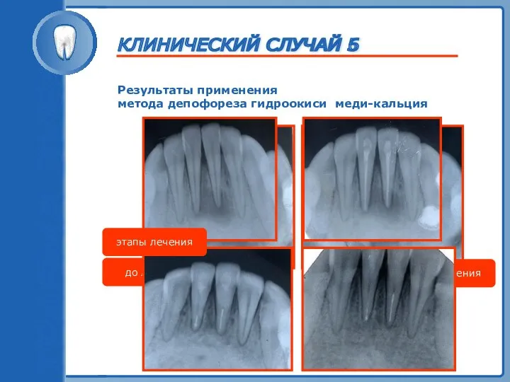 ТРАВМА ЗУБА Результаты применения метода депофореза гидроокиси меди-кальция до лечения после