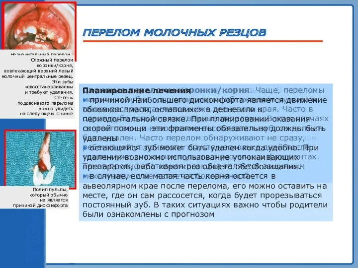 ТРАВМА ЗУБА ПЕРЕЛОМ МОЛОЧНЫХ РЕЗЦОВ Перелом коронки с обнажением пульпы. В