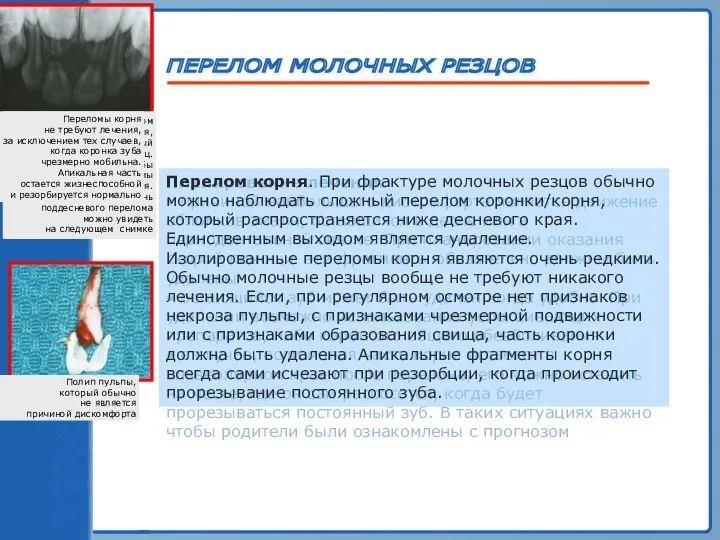 ТРАВМА ЗУБА ПЕРЕЛОМ МОЛОЧНЫХ РЕЗЦОВ Полип пульпы, который обычно не является