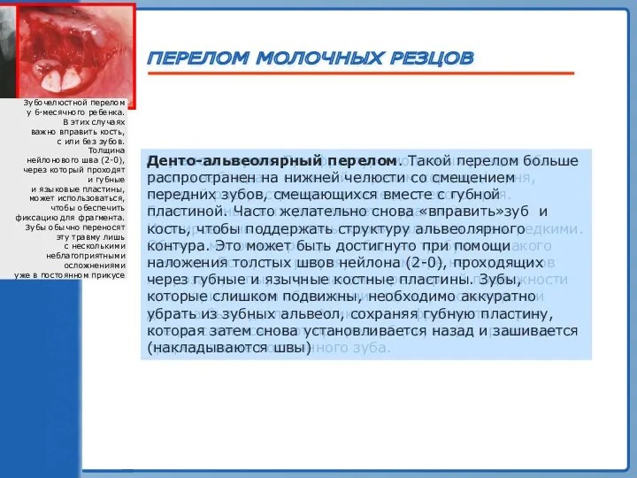 ТРАВМА ЗУБА ПЕРЕЛОМ МОЛОЧНЫХ РЕЗЦОВ Перелом корня. При фрактуре молочных резцов