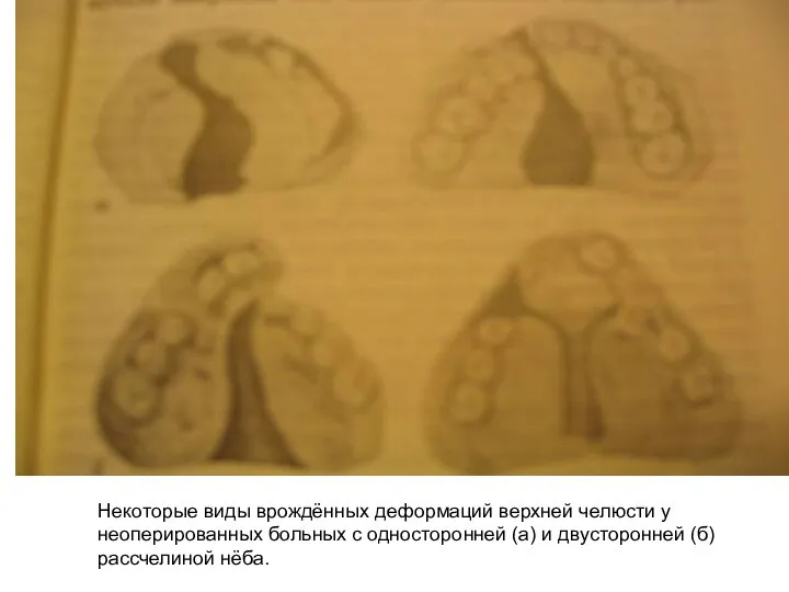 Некоторые виды врождённых деформаций верхней челюсти у неоперированных больных с односторонней