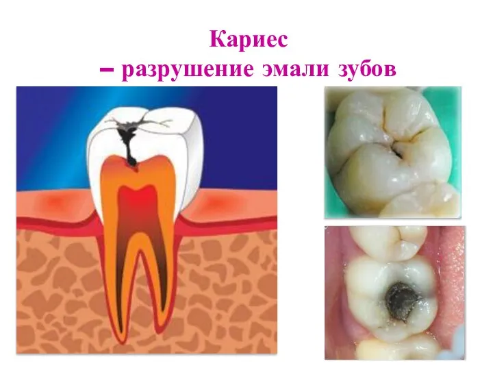 Кариес – разрушение эмали зубов