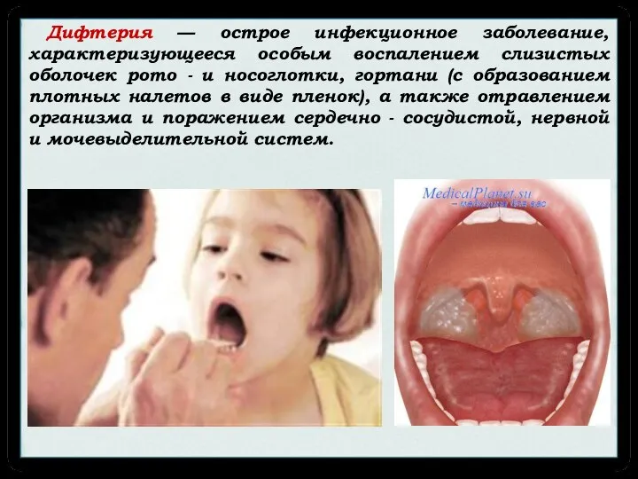 Дифтерия — острое инфекционное заболевание, характеризующееся особым воспалением слизистых оболочек рото