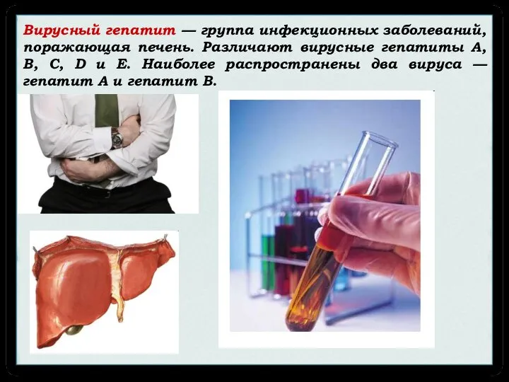 Вирусный гепатит — группа инфекционных заболеваний, поражающая печень. Различают вирусные гепатиты