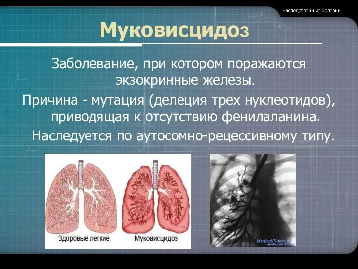 Муковисцидоз Заболевание, при котором поражаются экзокринные железы. Причина - мутация (делеция