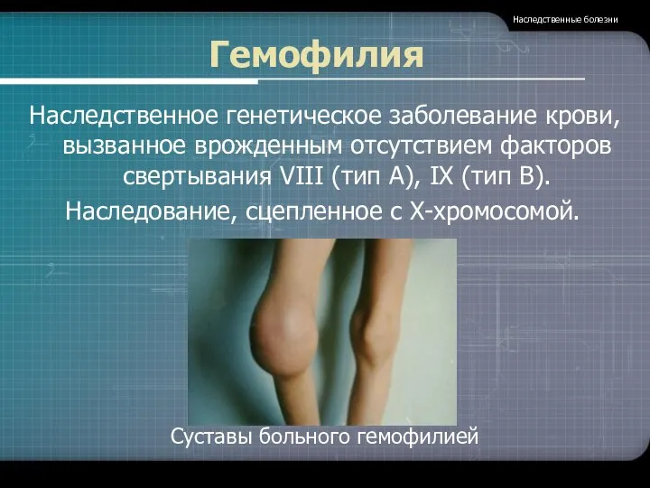 Гемофилия Наследственное генетическое заболевание крови, вызванное врожденным отсутствием факторов свертывания VIII