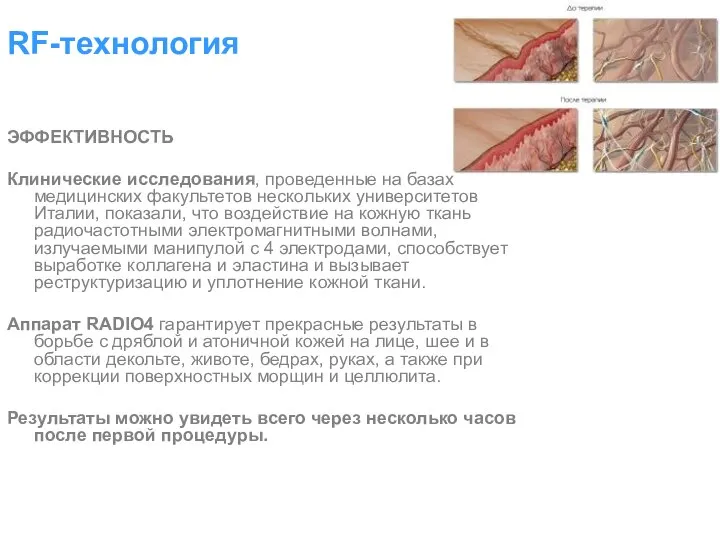 RF-технология ЭФФЕКТИВНОСТЬ Клинические исследования, проведенные на базах медицинских факультетов нескольких университетов