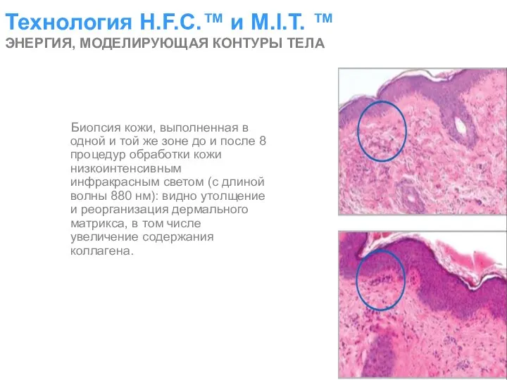 Технология H.F.C.™ и M.I.T. ™ ЭНЕРГИЯ, МОДЕЛИРУЮЩАЯ КОНТУРЫ ТЕЛА Биопсия кожи,