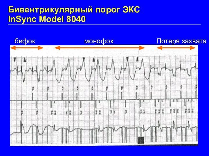 Бивентрикулярный порог ЭКС InSync Model 8040