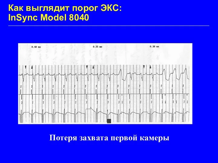 Как выглядит порог ЭКС: InSync Model 8040 Потеря захвата первой камеры