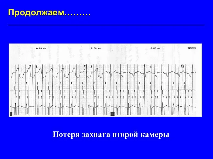 Продолжаем……… Потеря захвата второй камеры