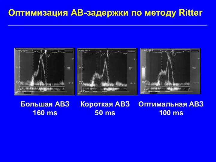 Оптимизация АВ-задержки по методу Ritter Большая АВЗ 160 ms Короткая АВЗ