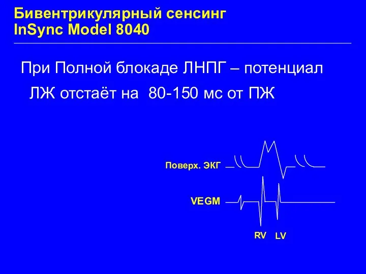 Бивентрикулярный сенсинг InSync Model 8040 При Полной блокаде ЛНПГ – потенциал