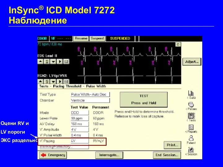 Оцени RV и LV пороги ЭКС раздельно InSync® ICD Model 7272 Наблюдение
