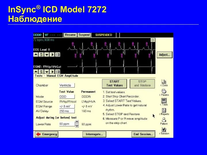 InSync® ICD Model 7272 Наблюдение