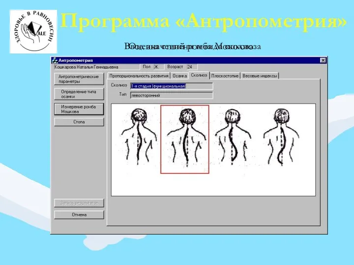 Программа «Антропометрия» Ввод значений ромба Мошкова Оценка степени и вида сколиоза