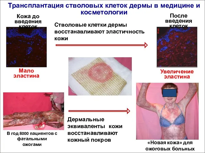 Трансплантация стволовых клеток дермы в медицине и косметологии Стволовые клетки дермы