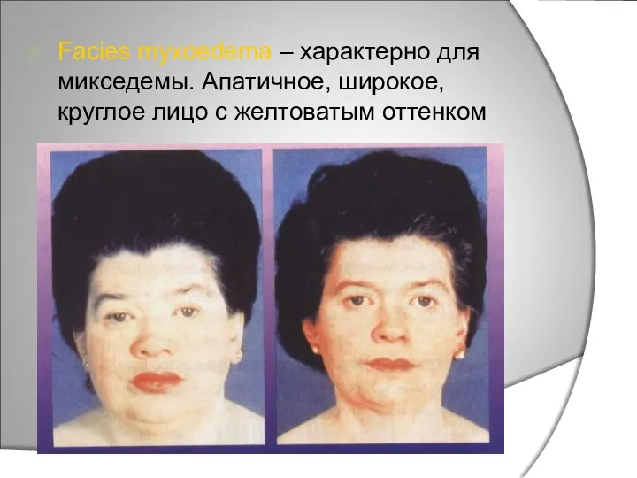 Facies myxoedema – характерно для микседемы. Апатичное, широкое, круглое лицо с желтоватым оттенком