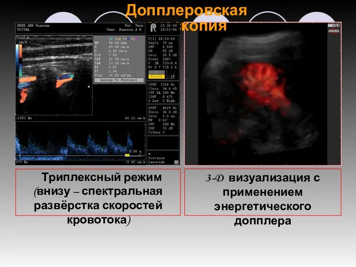 Триплексный режим (внизу – спектральная развёрстка скоростей кровотока) Допплеровская эхоскопия 3-D визуализация с применением энергетического допплера