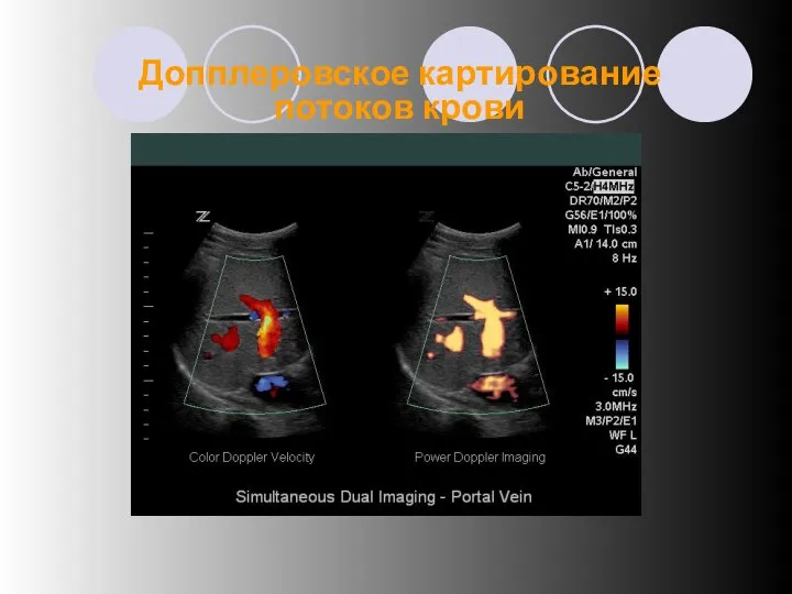 Допплеровское картирование потоков крови