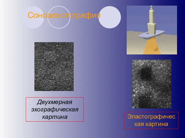 Соноэластография Эластографическая картина Двухмерная эхографическая картина