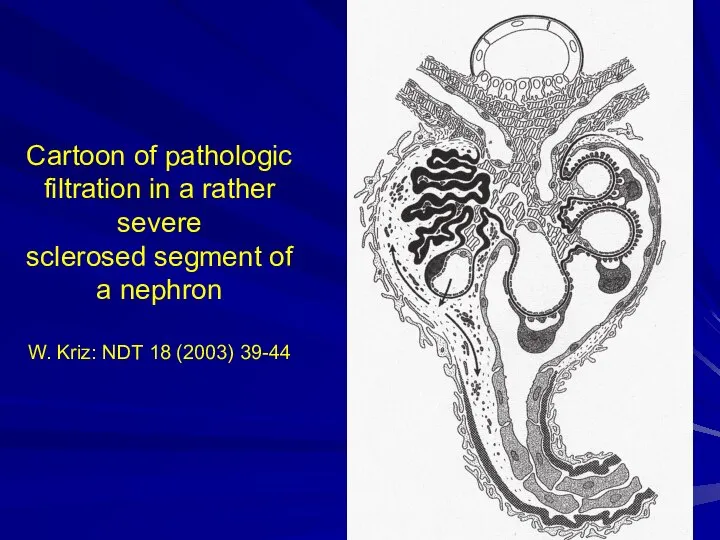 Cartoon of pathologic filtration in a rather severe sclerosed segment of