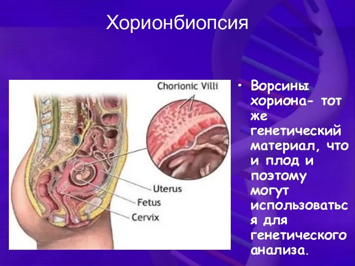 Хорионбиопсия Ворсины хориона- тот же генетический материал, что и плод и