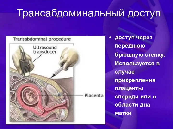 Трансабдоминальный доступ доступ через переднюю брюшную стенку. Используется в случае прикрепления