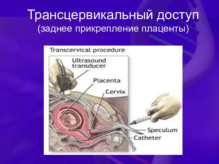 Трансцервикальный доступ (заднее прикрепление плаценты)