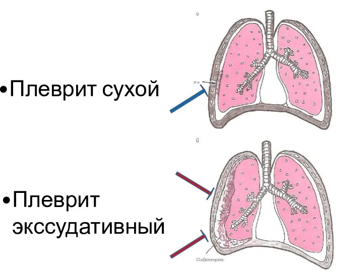 Плеврит сухой Плеврит экссудативный