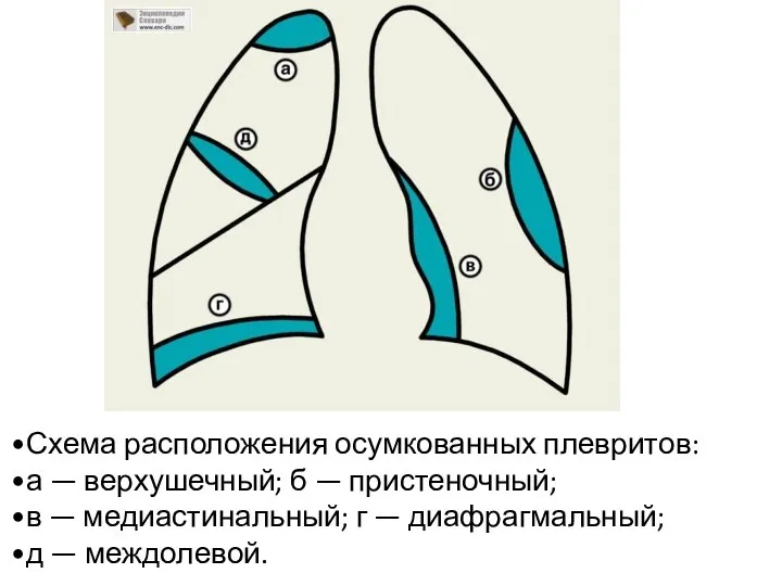 Схема расположения осумкованных плевритов: а — верхушечный; б — пристеночный; в