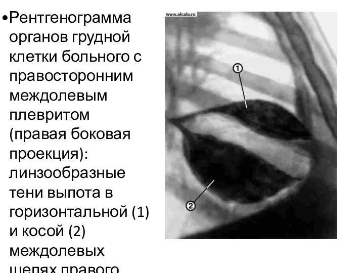 Рентгенограмма органов грудной клетки больного с правосторонним междолевым плевритом (правая боковая