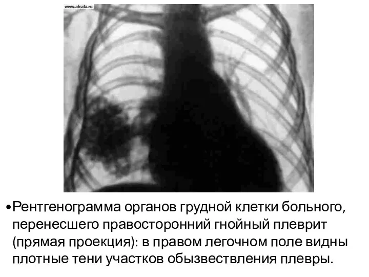 Рентгенограмма органов грудной клетки больного, перенесшего правосторонний гнойный плеврит (прямая проекция):