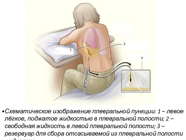 Схематическое изображение плевральной пункции: 1 – левое лёгкое, поджатое жидкостью в